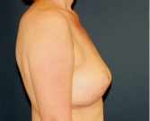 Feel Beautiful - Breast Implant Removal 203 - After Photo